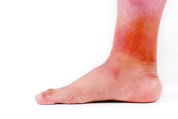 ஆயுள் காக்கும் ஆயுர்வேதம்: படை குணமாக வழி என்ன?