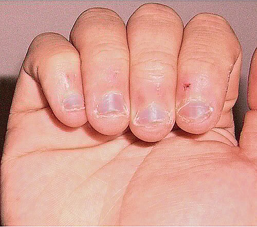 ஆயுள் காக்கும் ஆயுர்வேதம்: விரல் புண் குணமாக வழி என்ன?