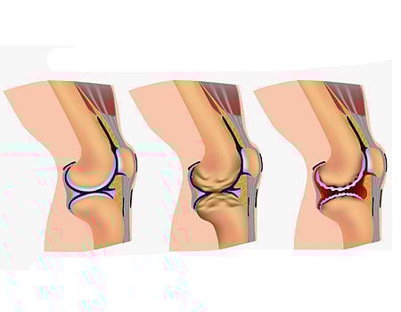 மூட்டு வலியினால் அவதிப்படுபவர்களுக்கு நிவாரணம் தரும் கசாயம் 