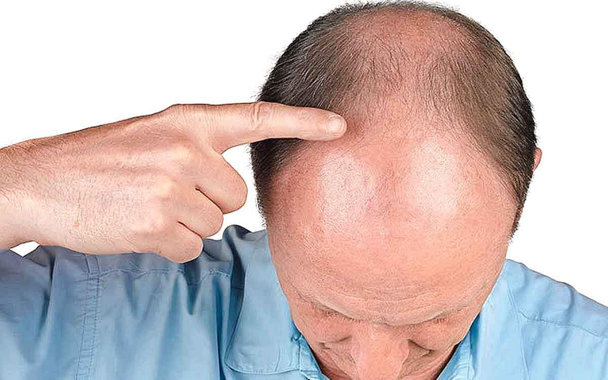 ஆயுள் காக்கும் ஆயுர்வேதம்: முன்தலை வழுக்கை குணப்படுத்துவது எப்படி?