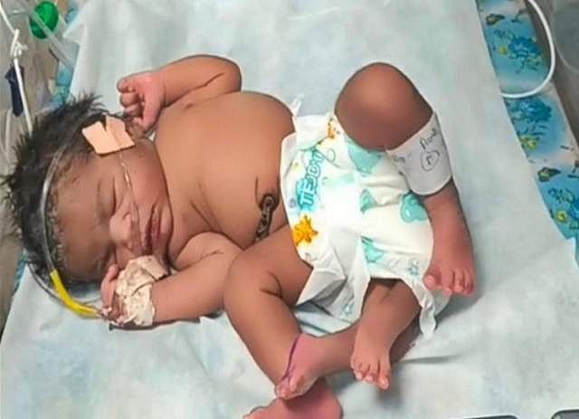 நான்கு கால்களுடன் பிறந்த அதிசய குழந்தை: எங்கே தெரியுமா?