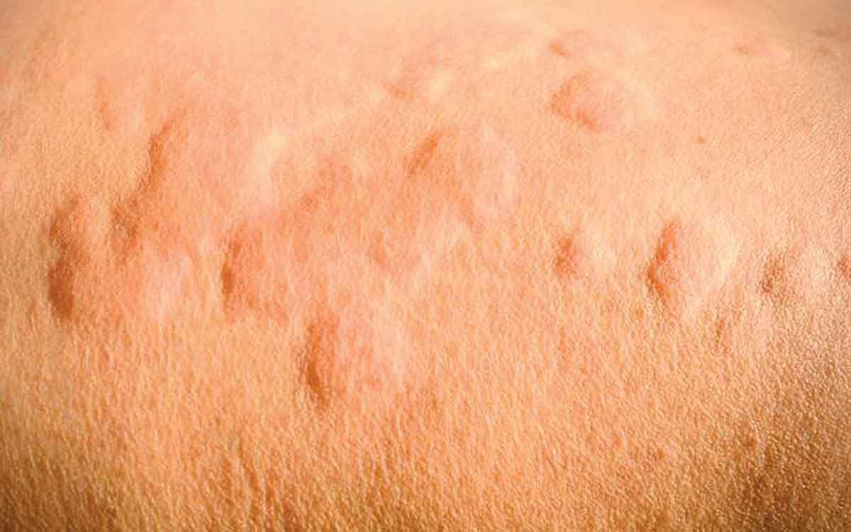 ஆயுள் காக்கும் ஆயுர்வேதம்: உடல் அரிப்பு நீங்க வழி என்ன?