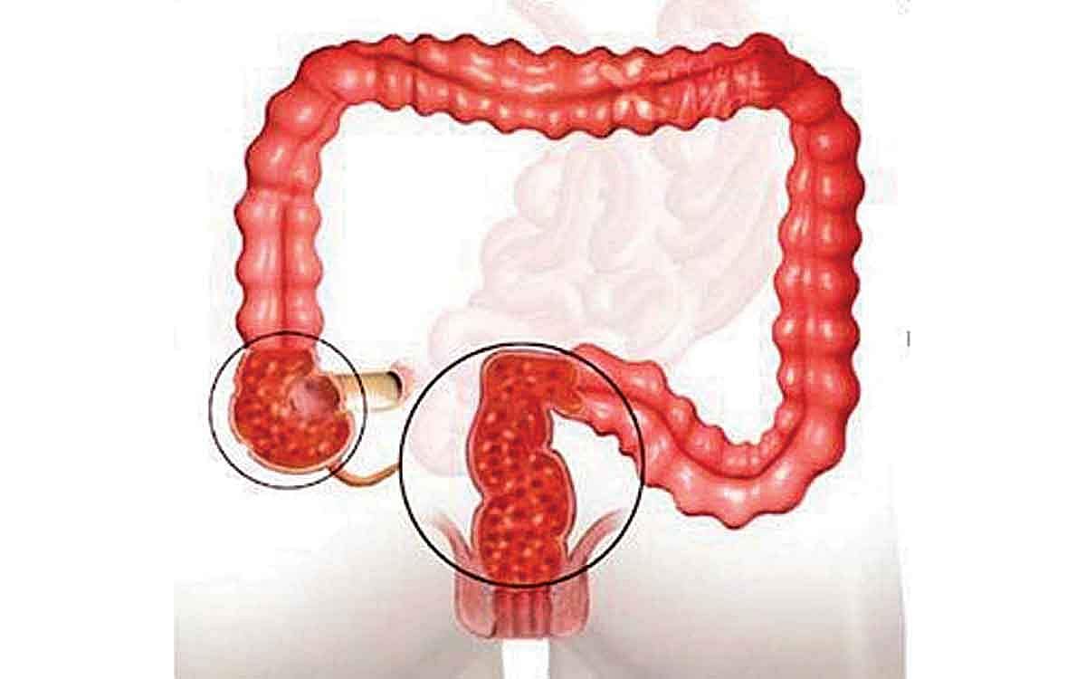 ஆயுள் காக்கும் ஆயுர்வேதம்: பெருங்குடல் அழற்சிக்கு தீர்வு என்ன?